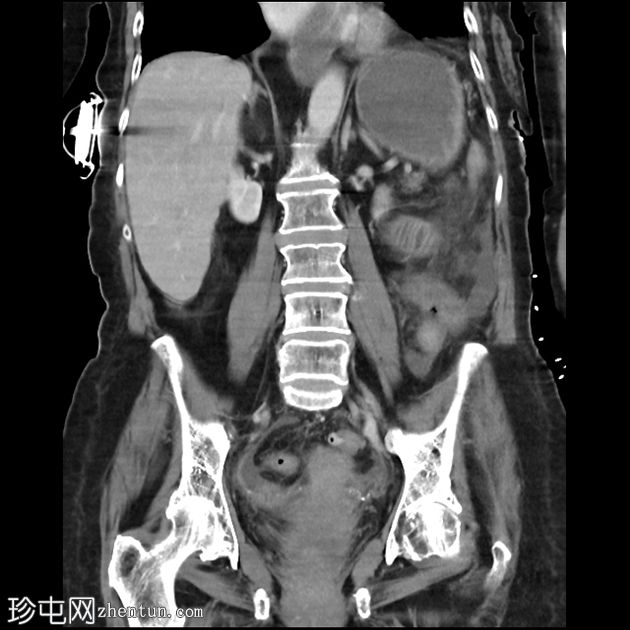 胆石性肠梗阻