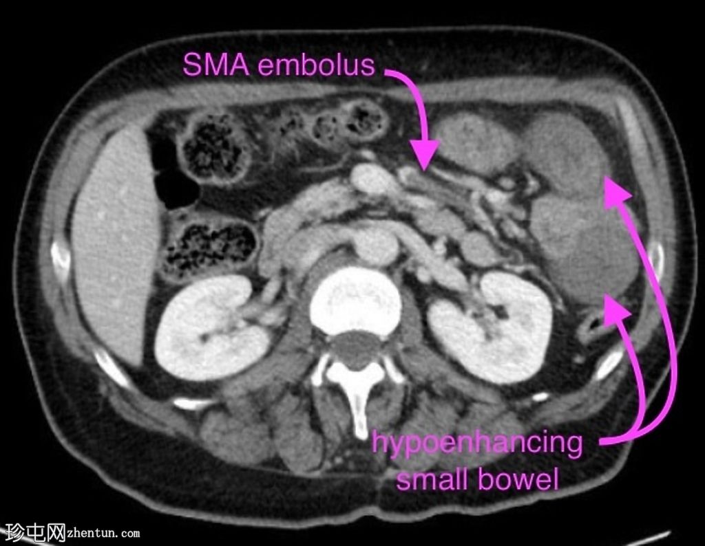 SMA栓子引起的小肠/肠系膜缺血