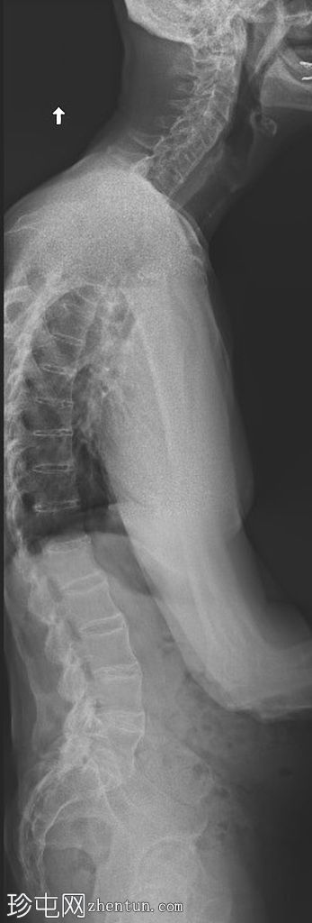 强直性脊柱炎中髂腰韧带骨化
