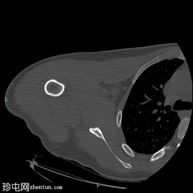 用于治疗盂肱后部不稳定的后骨阻滞