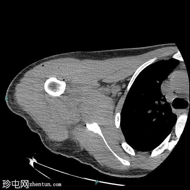 用于治疗盂肱后部不稳定的后骨阻滞