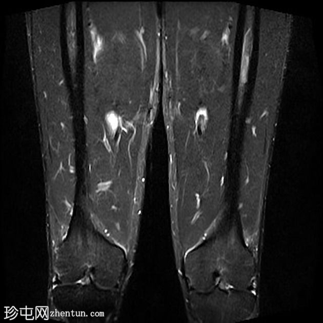 血管周围内收长肌损伤