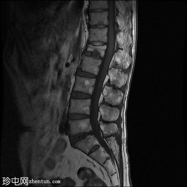 孤立性骨浆细胞瘤