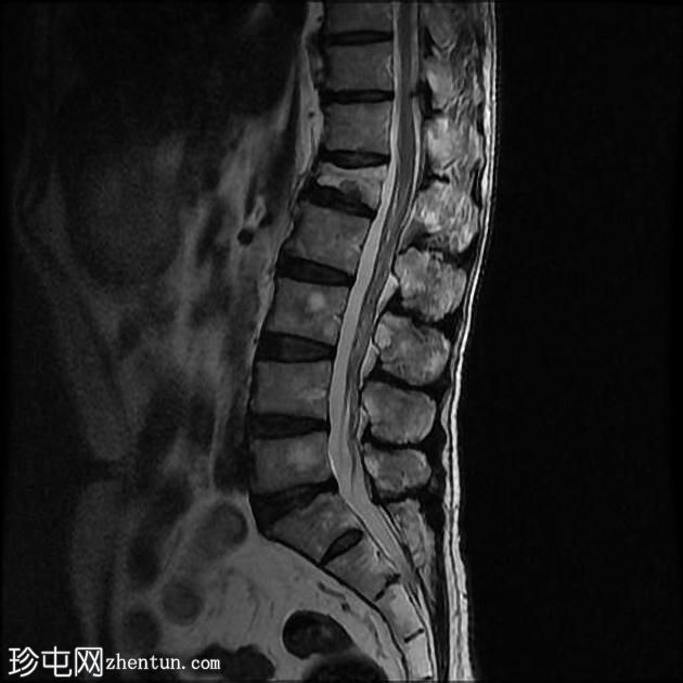 孤立性骨浆细胞瘤