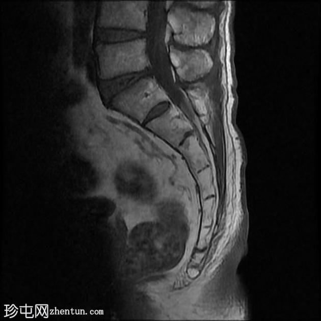 孤立性骨浆细胞瘤