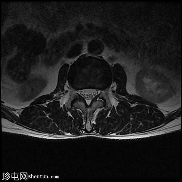 孤立性骨浆细胞瘤