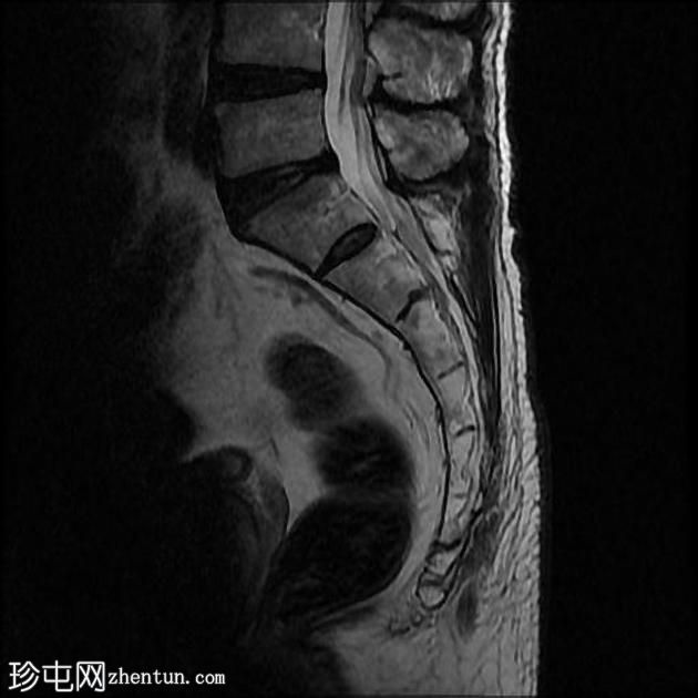 孤立性骨浆细胞瘤