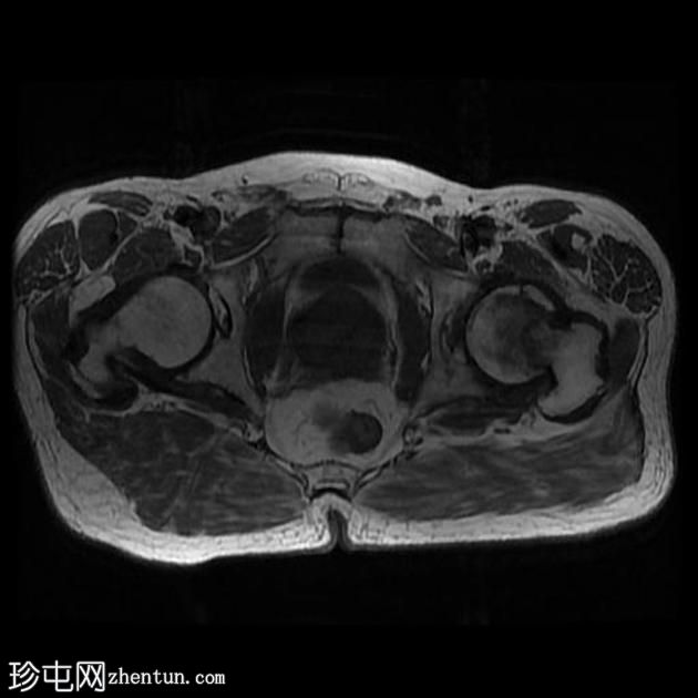 髋关节骨关节炎 - MRI