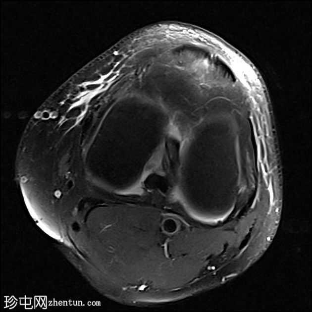 髌腱腱内腱鞘囊肿