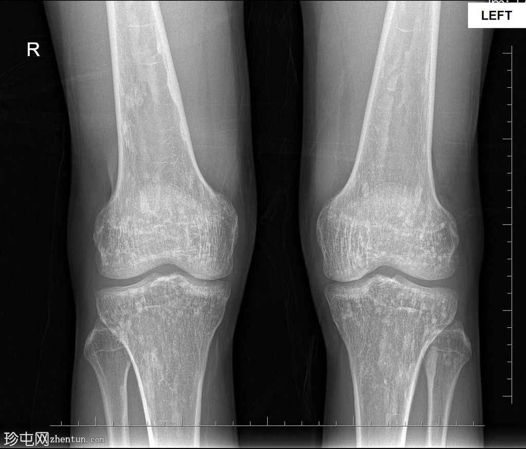 骨斑点症(脆弱性骨硬化)(Osteopoikilosis)