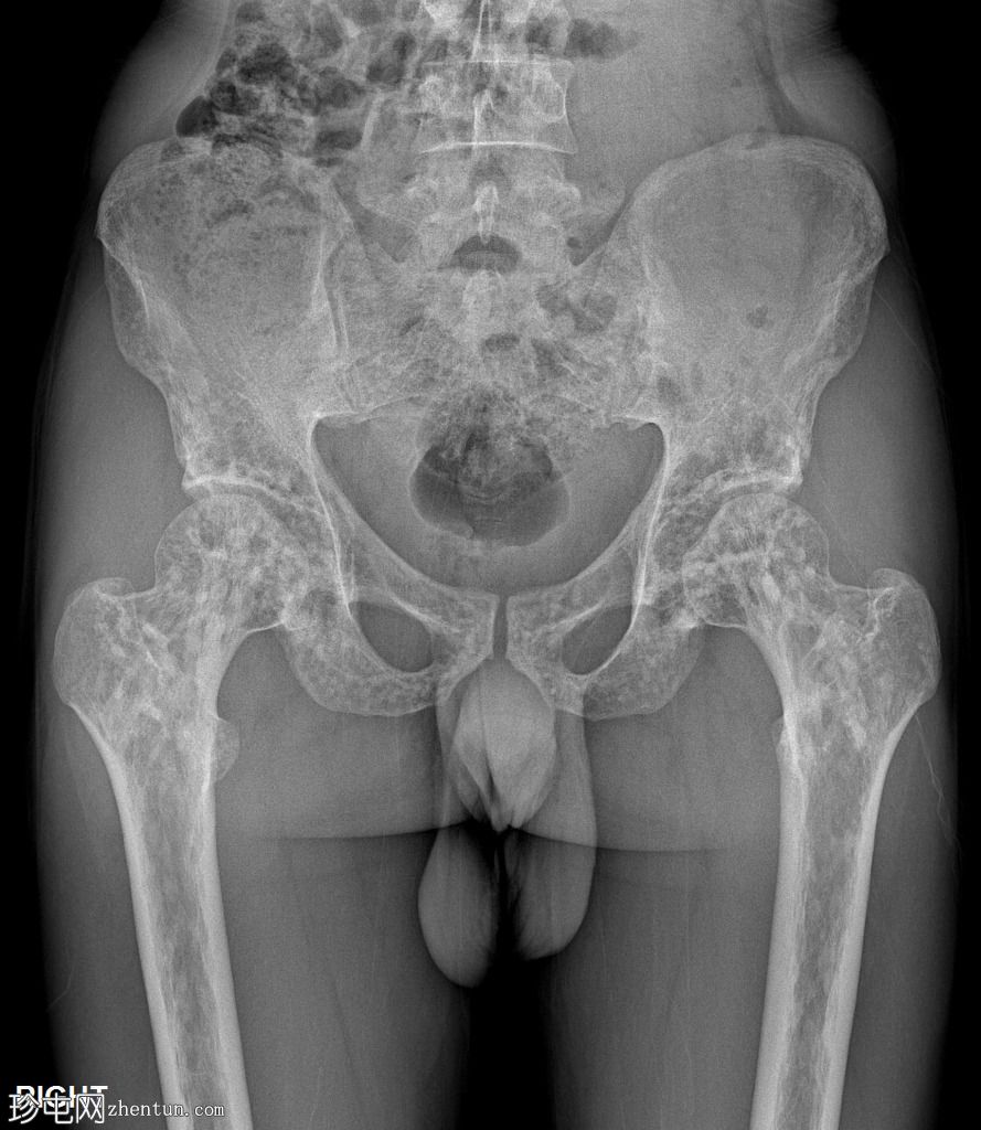 骨斑点症(脆弱性骨硬化)(Osteopoikilosis)