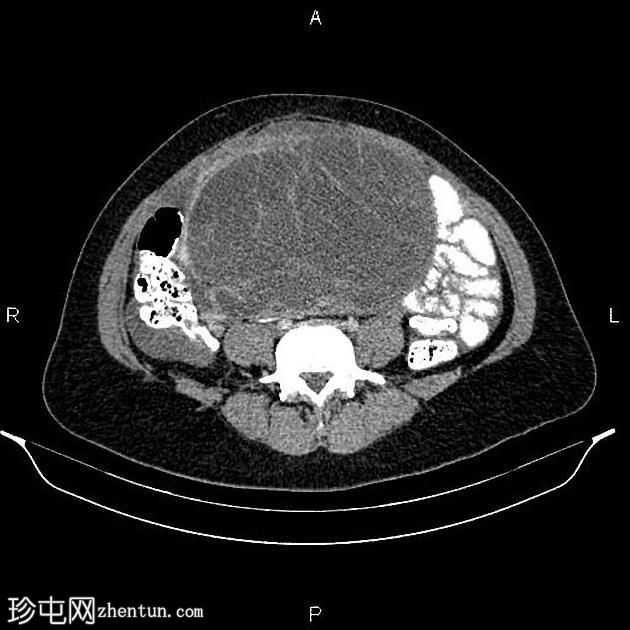 卵巢浆液性囊腺癌