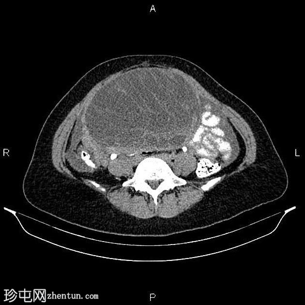 卵巢浆液性囊腺癌