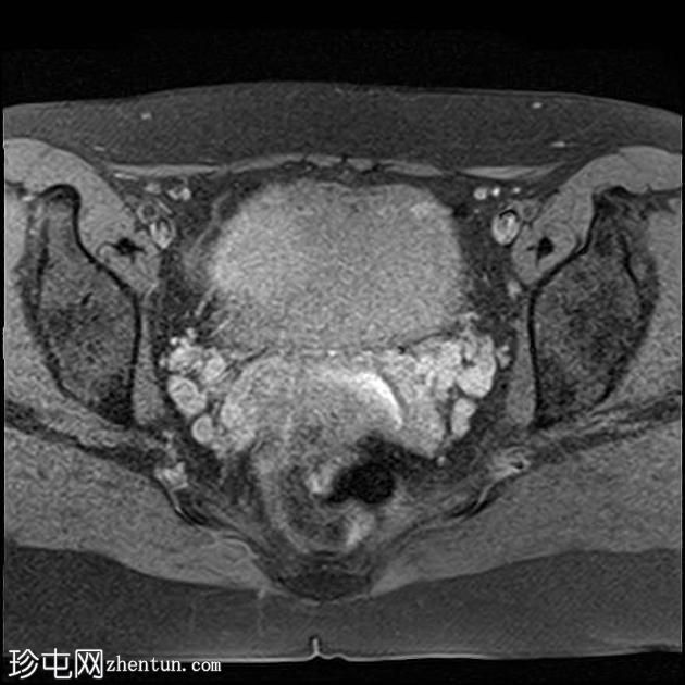 弥漫性腺肌病 - 卵巢皮样囊肿