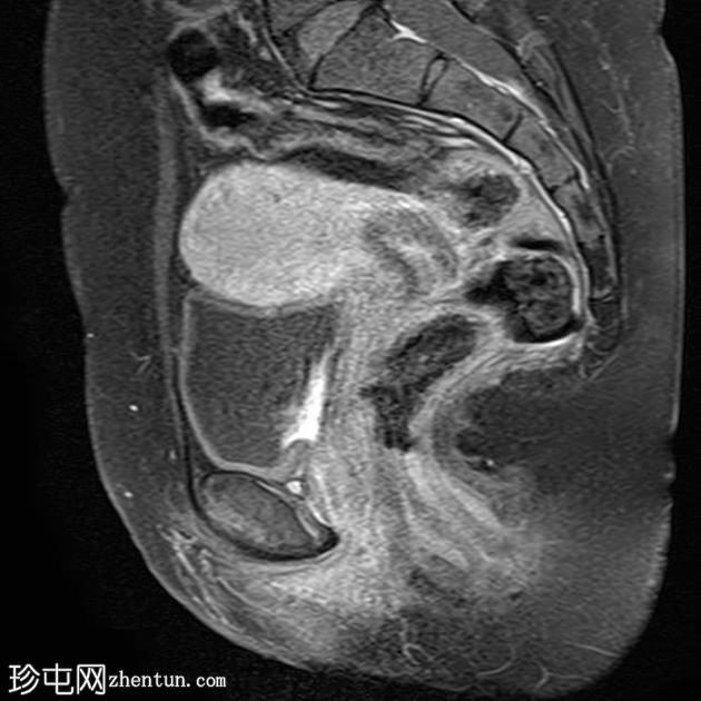 弥漫性腺肌病 - 卵巢皮样囊肿