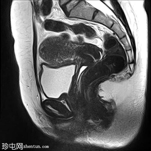 弥漫性腺肌病 - 卵巢皮样囊肿