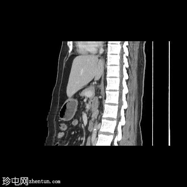 双侧梗阻性肾病伴肾盂肾炎