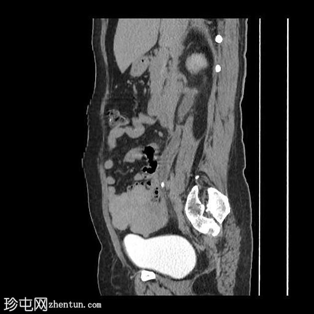 双侧梗阻性肾病伴肾盂肾炎