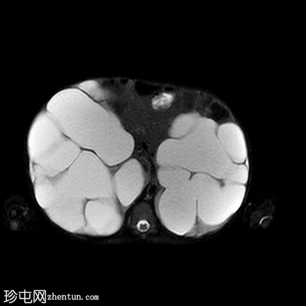 来自后尿道瓣膜的严重双侧输尿管积水