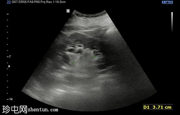 囊性肾血管平滑肌脂肪瘤 (CEUS)
