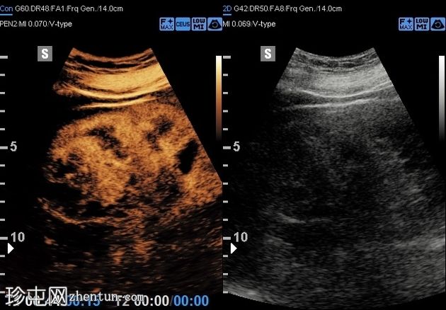 囊性肾血管平滑肌脂肪瘤 (CEUS)