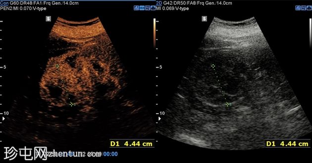 囊性肾血管平滑肌脂肪瘤 (CEUS)