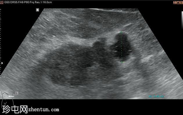 无定形 Bosniak 1 肾囊肿 (CEUS)