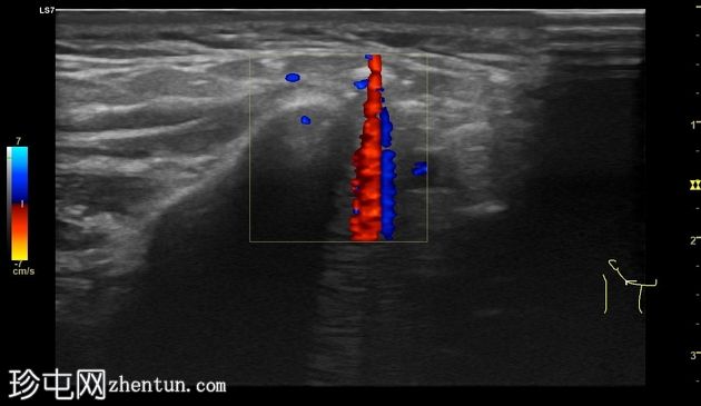 腮腺积气(Pneumoparotid)