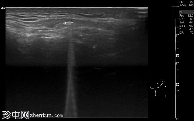 腮腺积气(Pneumoparotid)