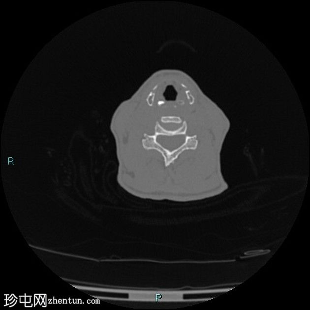 颧骨可注射填充物及相关并发症