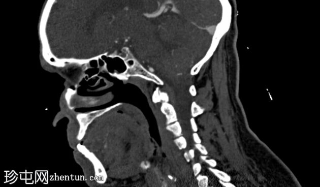 Eagle综合征伴左颈内动脉受压
