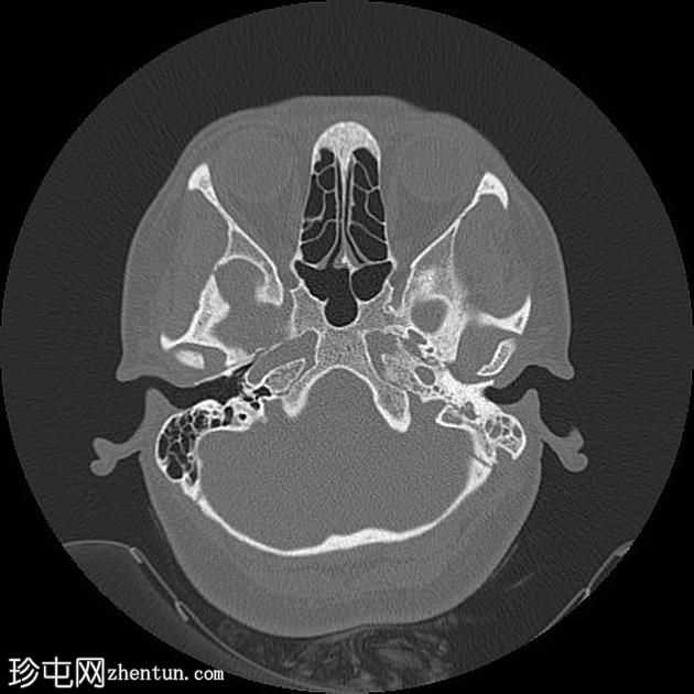 慢性中耳炎