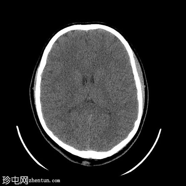 视盘玻璃膜疣