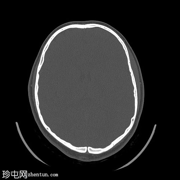 视盘玻璃膜疣