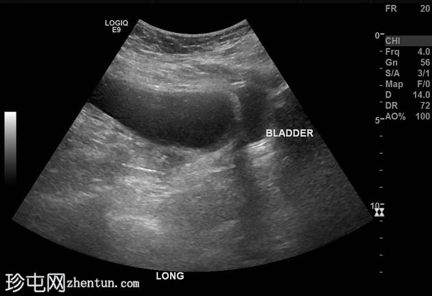 卵巢粘液性囊腺瘤，类似膀胱