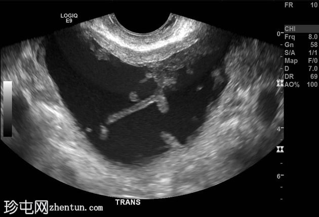 卵巢粘液性囊腺瘤，类似膀胱