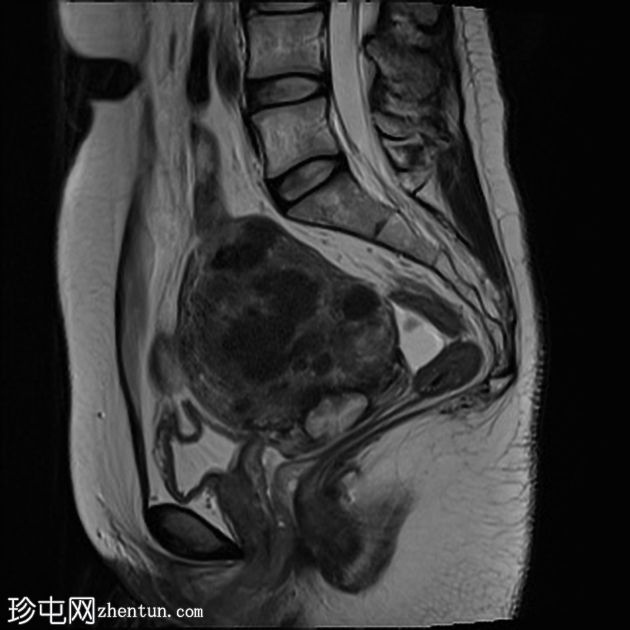 弥漫性子宫平滑肌瘤病