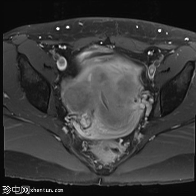 弥漫性子宫平滑肌瘤病