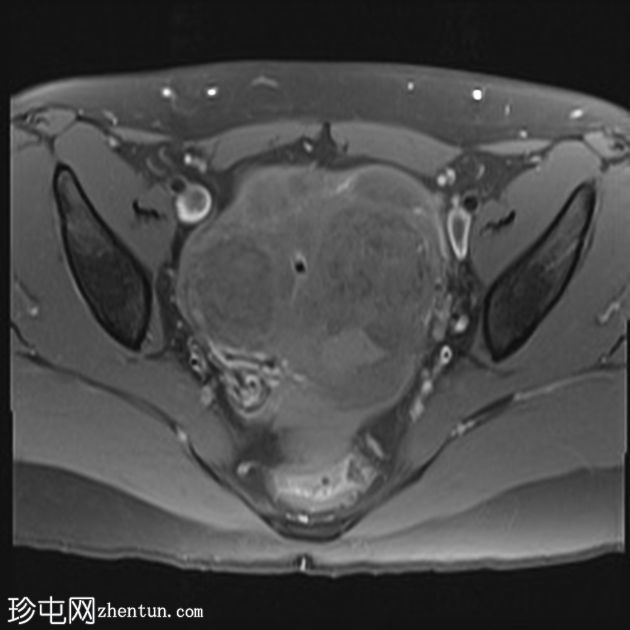 弥漫性子宫平滑肌瘤病