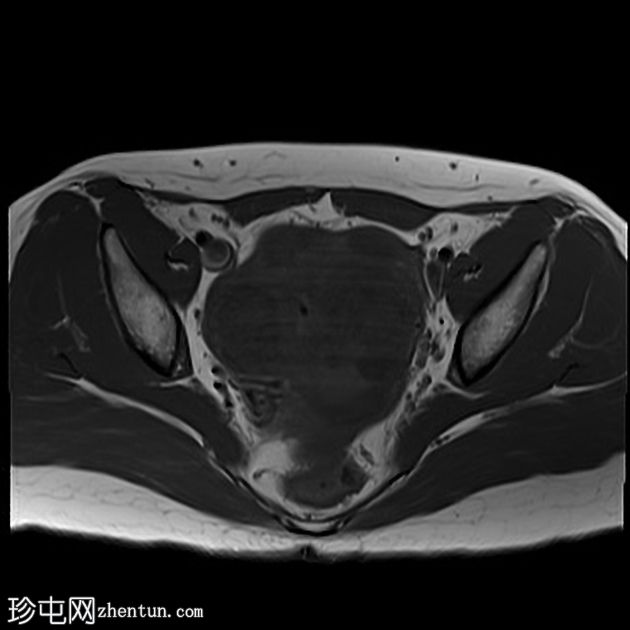 弥漫性子宫平滑肌瘤病