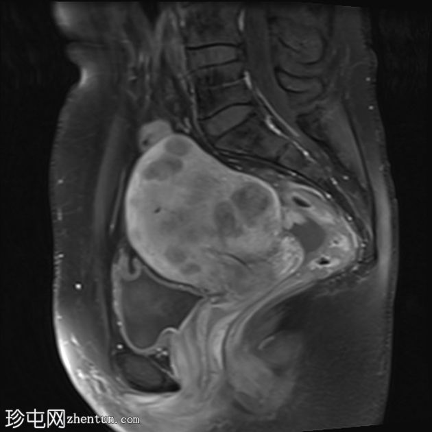 弥漫性子宫平滑肌瘤病