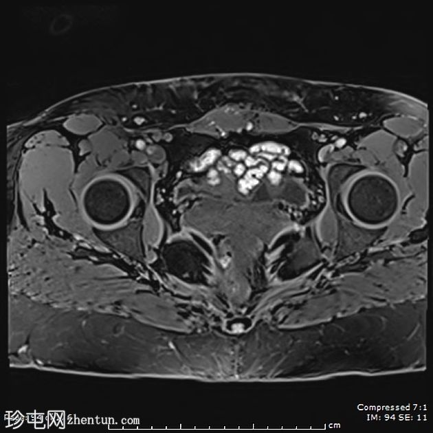 子宫内膜异位症——腹直肌