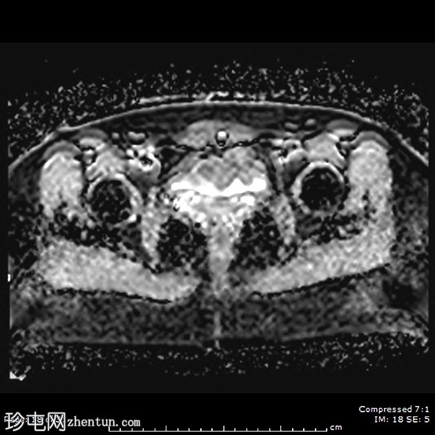 子宫内膜异位症——腹直肌