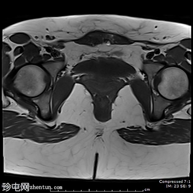 子宫内膜异位症——腹直肌