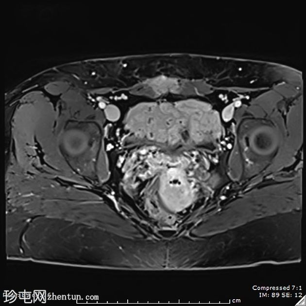 子宫内膜异位症——腹直肌