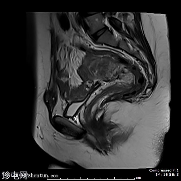 子宫内膜异位症——腹直肌