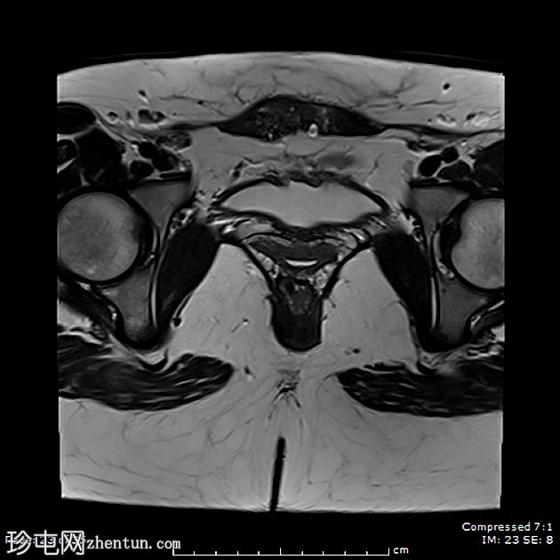 子宫内膜异位症——腹直肌