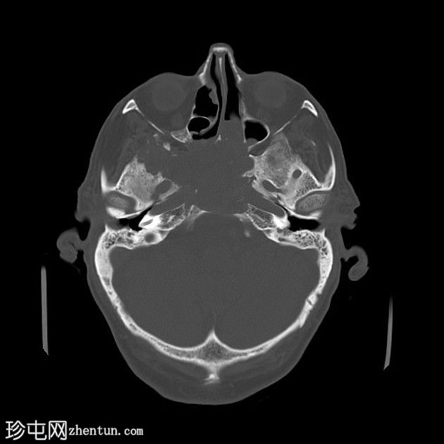 鼻窦骨化性纤维黏液样肿瘤