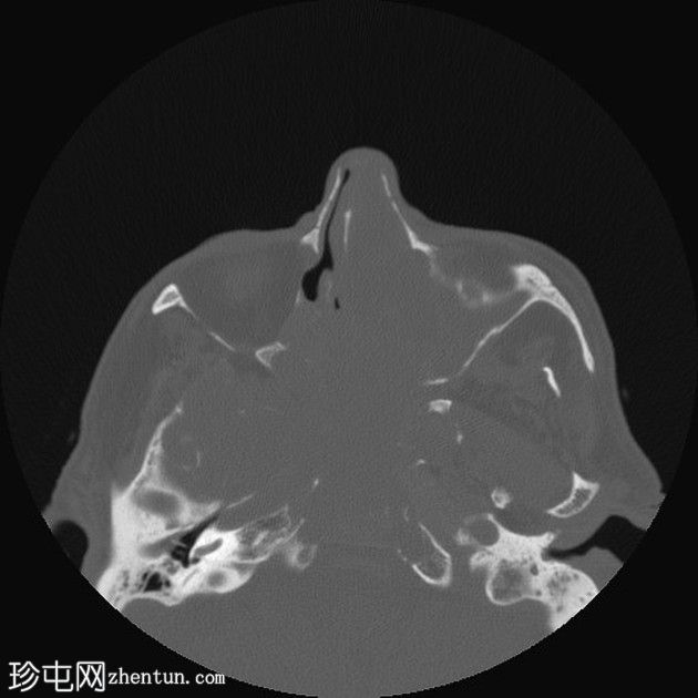 鼻窦骨化性纤维黏液样肿瘤