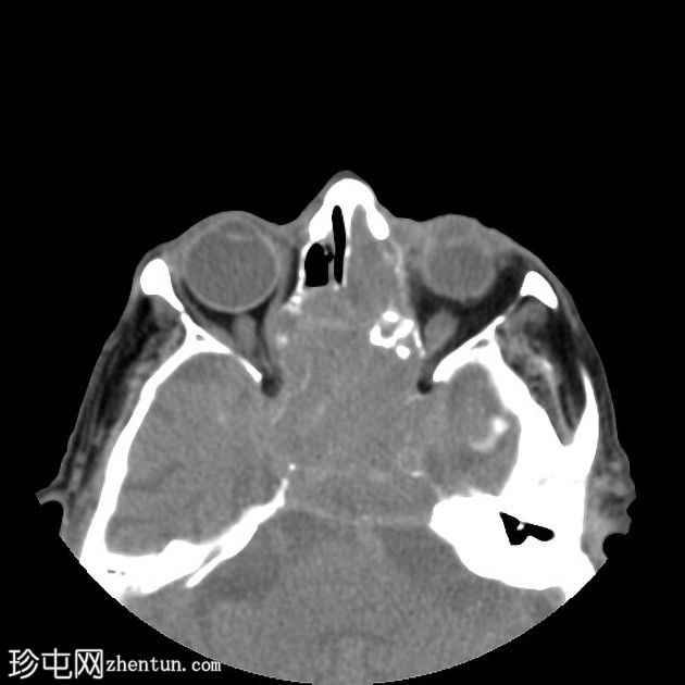 鼻窦骨化性纤维黏液样肿瘤